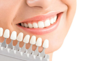 Carillas dentales: Qué son y qué tipos hay