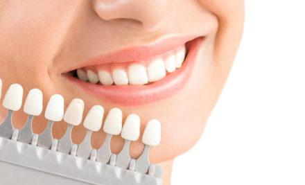 Carillas dentales: Qué son y qué tipos hay