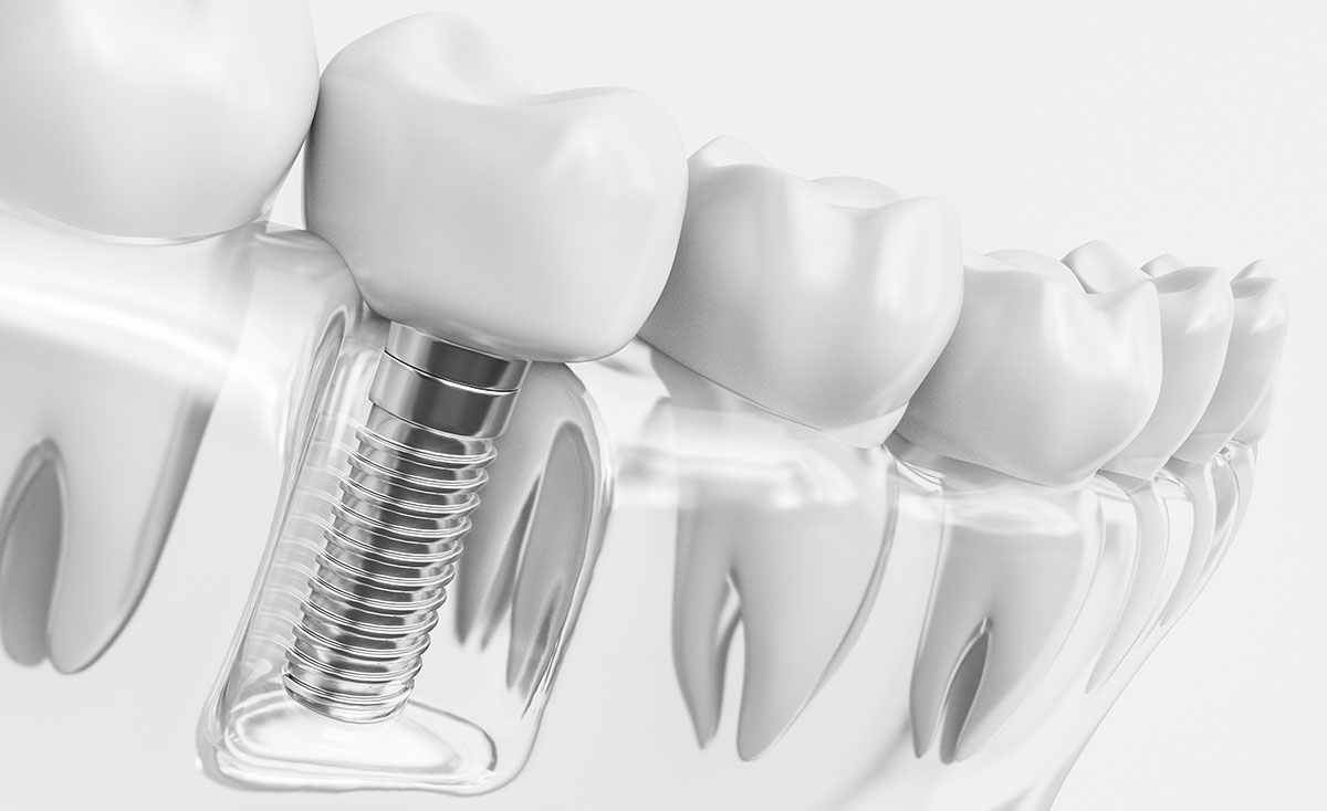 ¿Qué son los Implantes Dentales y para qué sirven?