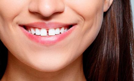 Diastema: La moda de los dientes separados