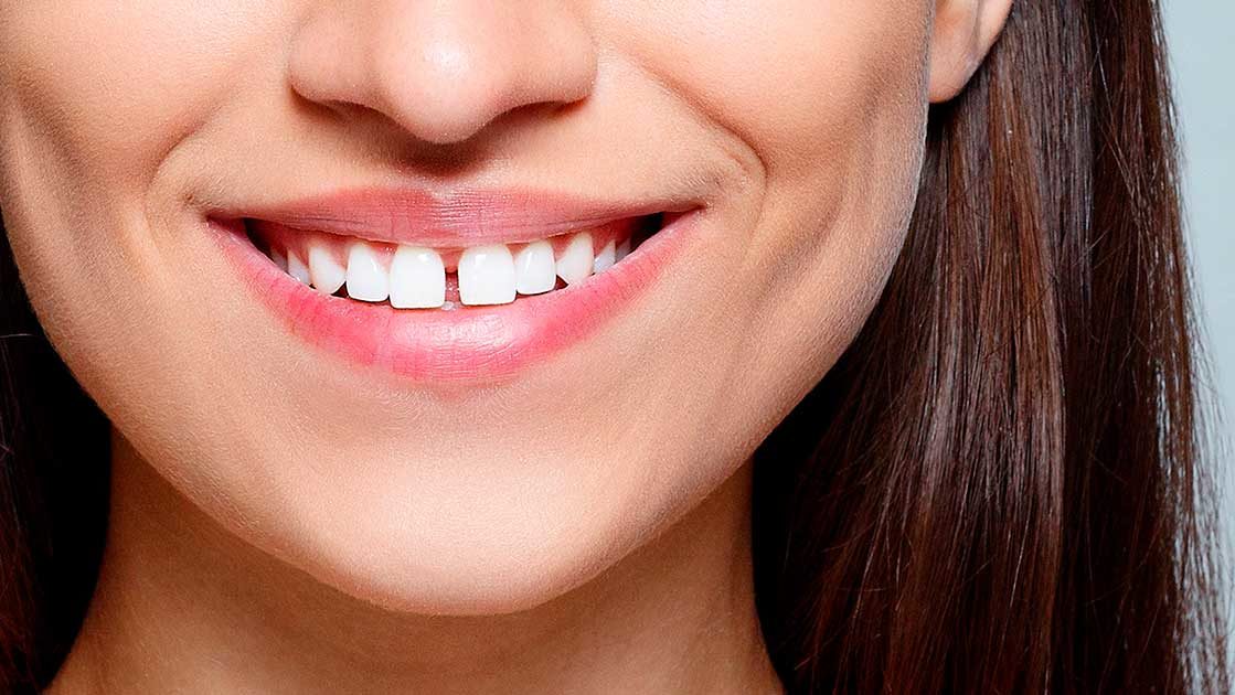 Diastema: La moda de los dientes separados
