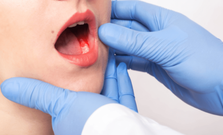 Cáncer de boca y garganta: causas principales
