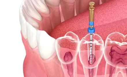 Endodoncia: ¿Para qué sirve?